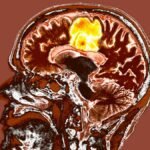 Новый метод лечения самого агрессивного рака мозга может помочь пациентам жить дольше