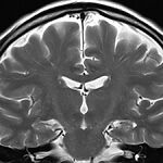 Повреждения головного мозга отмечены у 13% детей, умерших от гриппа в этом сезоне, сообщает CDC